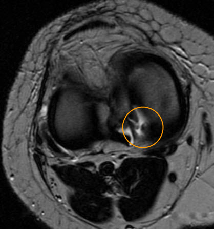 Medial meniscus posterior root tear | Image | Radiopaedia.org