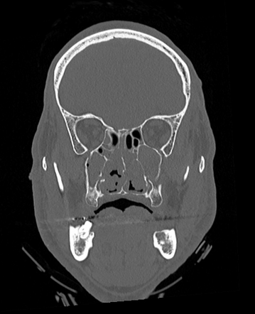 Right le Fort 1 fracture and left Le Fort 2 fracture | Radiology Case ...