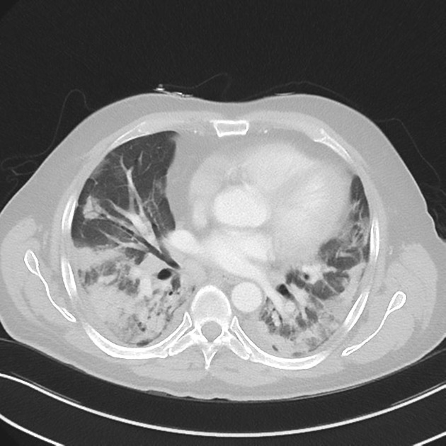 Featured image of post Radiopaedia Organizing Pneumonia Lobular pneumonia is a general segmental pneumonia is the sixth leading cause of death and the number 1 cause of death from