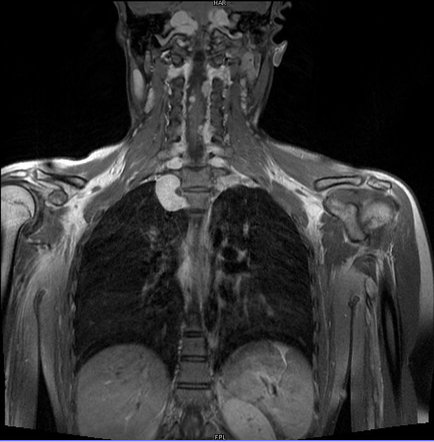 Neurogenic tumors | Radiology Reference Article | Radiopaedia.org