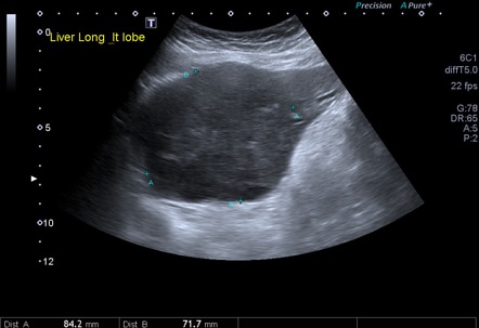 Hepatic carcinosarcoma | Radiology Reference Article | Radiopaedia.org