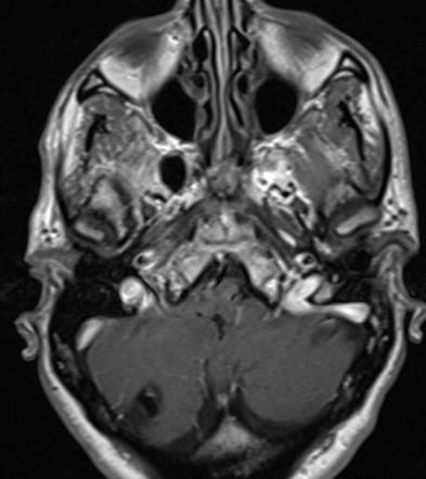 Multiple cavernous malformations | Image | Radiopaedia.org