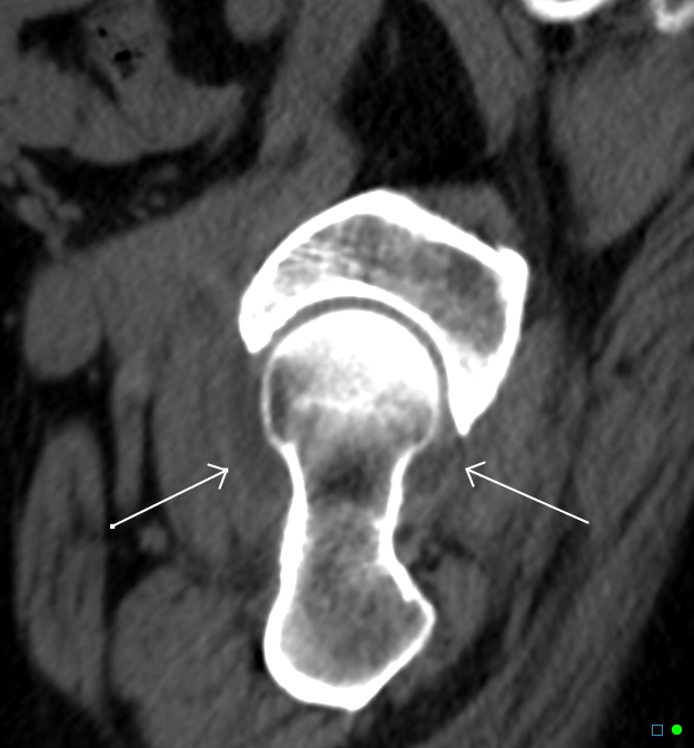 hip-joint-effusion-image-radiopaedia