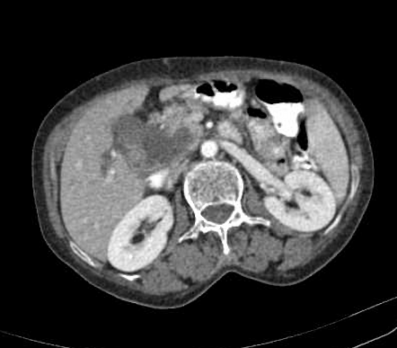 Cholangiocarcinoma | Radiology Case | Radiopaedia.org