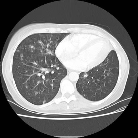 Multifocal adenocarcinoma of lung | Radiology Case | Radiopaedia.org