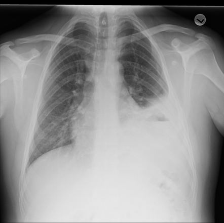 Delayed traumatic diaphragm rupture | Image | Radiopaedia.org