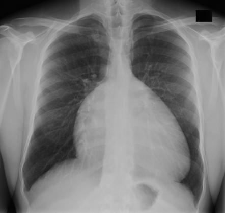 Right atrial enlargement | Radiology Reference Article | Radiopaedia.org