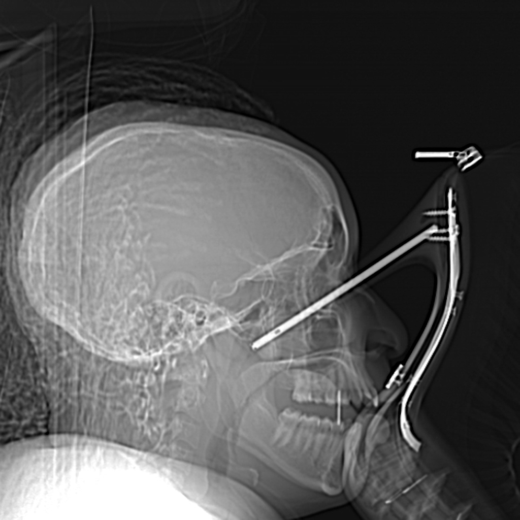 fractured eye socket x ray