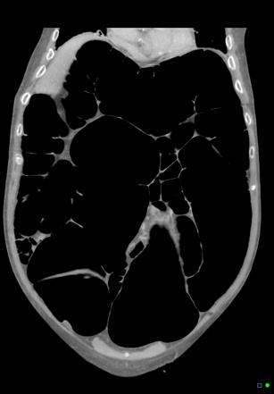 Colonic pseudo-obstruction | Radiology Reference Article | Radiopaedia.org