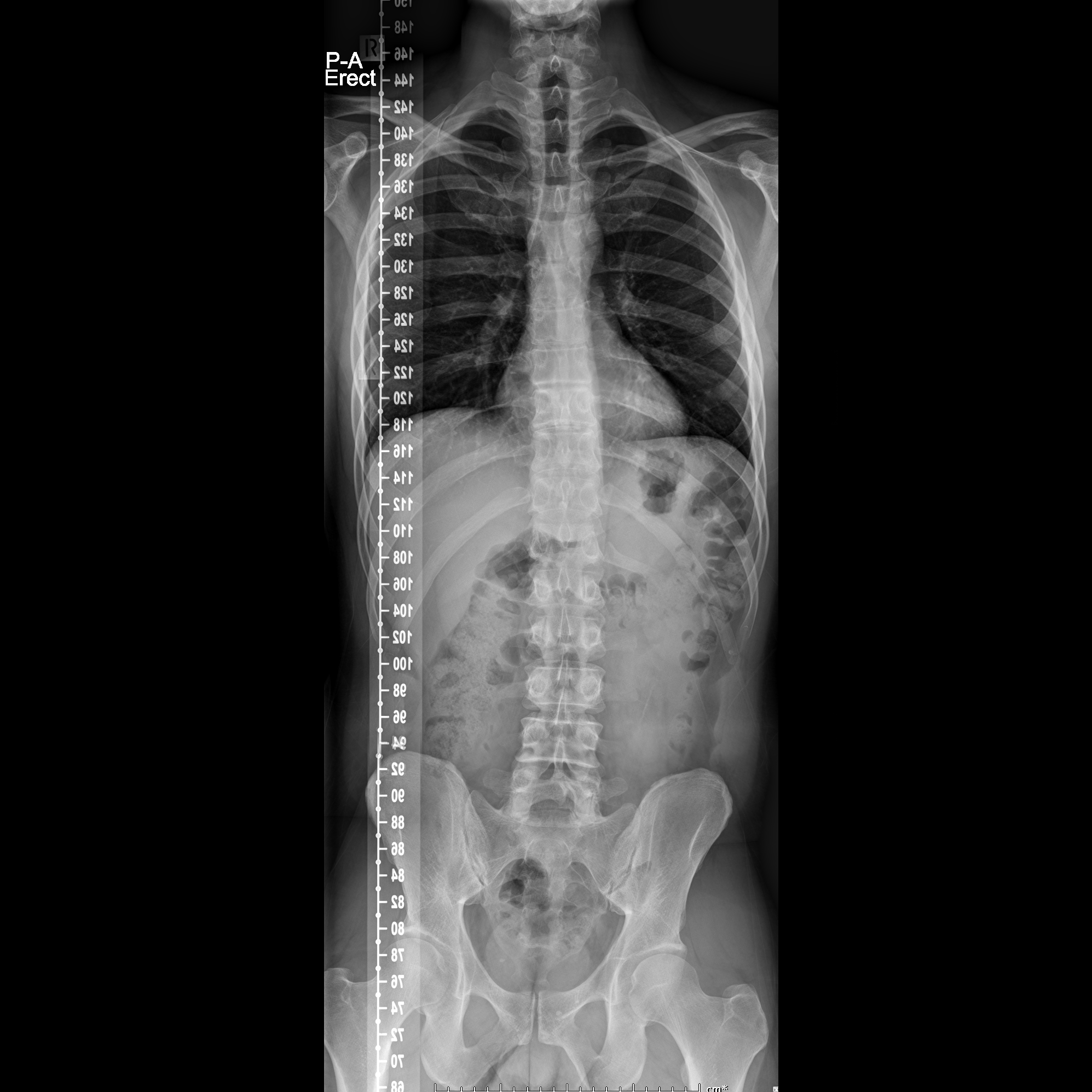 Снимок позвоночника. Грудной отдел позвоночника рентген норма. Spine XRAY. Грудной отдел позвонки рентген. Рентген грудного отдела норма.