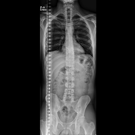 Long spine x-rays (minimal scoliosis) | Radiology Case | Radiopaedia.org