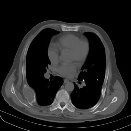 Lucent/lytic rib lesion (mnemonic) | Radiology Reference Article ...