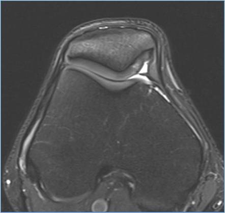 Synovial plicae (knee) | Radiology Reference Article | Radiopaedia.org