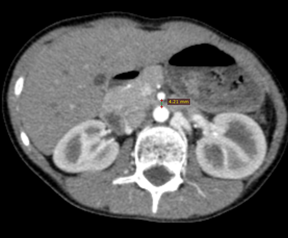 Superior mesenteric artery syndrome | Image | Radiopaedia.org