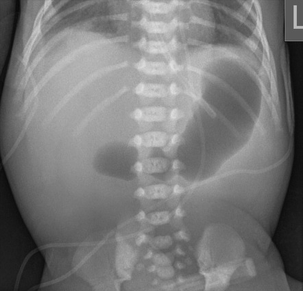 Duodenal atresia | Radiology Case | Radiopaedia.org