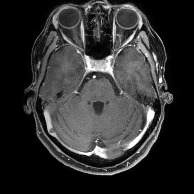 Paraneoplastic Limbic Encephalitis Image