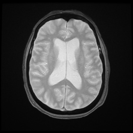 Paraneoplastic limbic encephalitis | Image | Radiopaedia.org