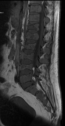 Multiple myeloma | Radiology Reference Article | Radiopaedia.org