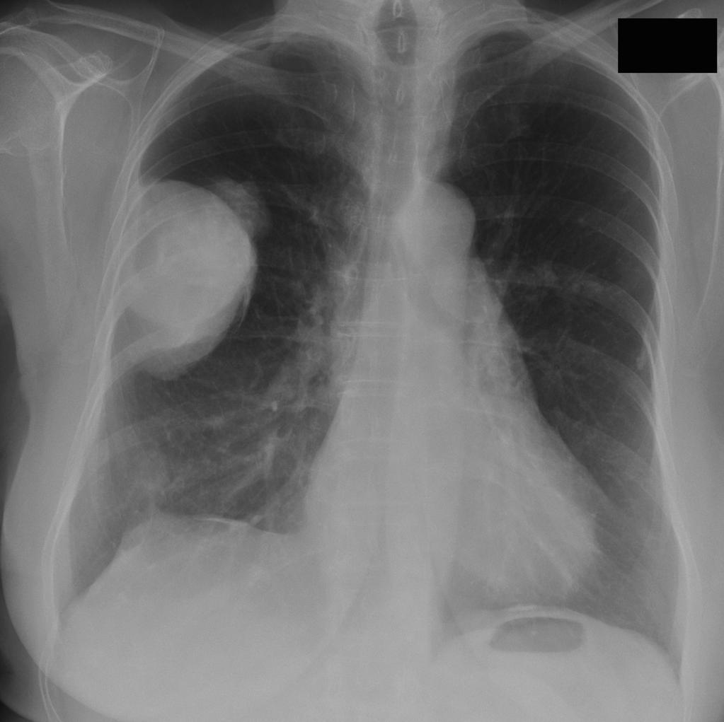 Sarcomatoid Mesothelioma Radiology Case Radiopaedia Org