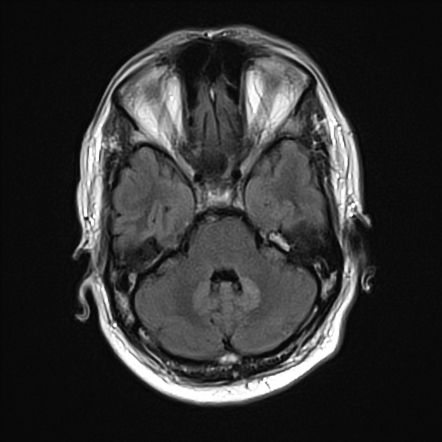 Metronidazole toxicity in humans