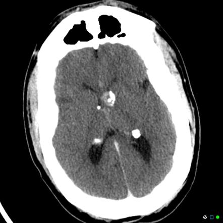 Tuberous sclerosis - giant cell astrocytoma | Radiology Case ...