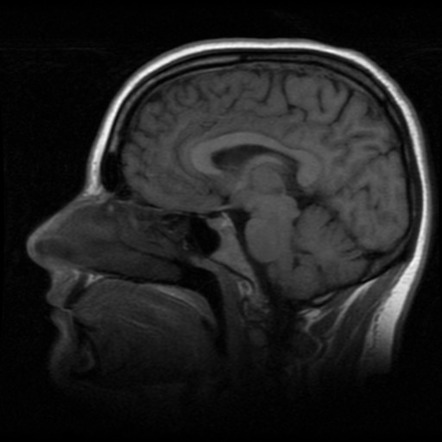 Astrocytoma, IDH mutant Grade 4 | Image | Radiopaedia.org