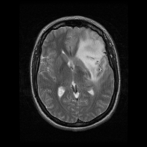 Astrocytoma IDH Mutant Grade Image Radiopaedia Org