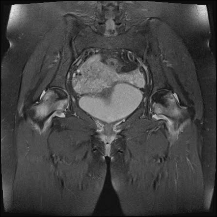 Avascular necrosis of hip (MRI) | Radiology Case | Radiopaedia.org