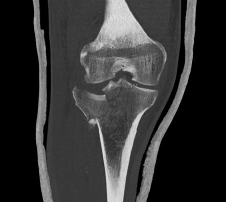 Tibial plateau fracture - Schatzker type VI | Radiology Case ...