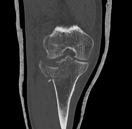 Tibial plateau fracture - Schatzker type VI | Image | Radiopaedia.org