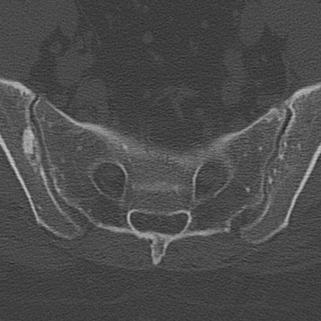 Osteoid Lesions Radiology Reference Article Radiopaedia Org