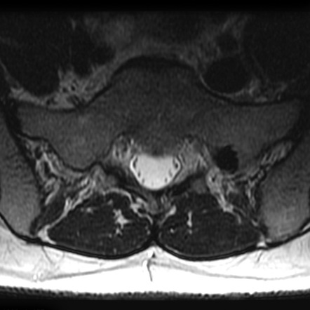 Bone island | Radiology Reference Article | Radiopaedia.org