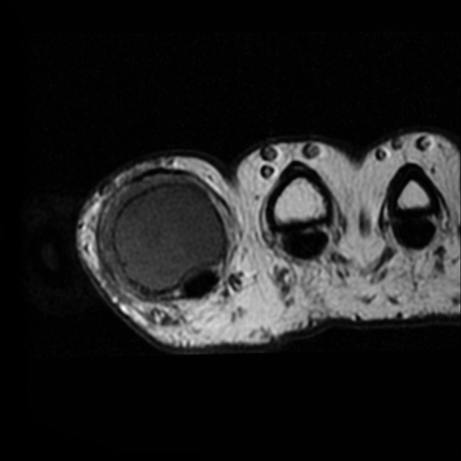 Enchondroma - metacarpal | Image | Radiopaedia.org