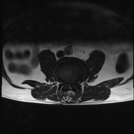 Osteosclerosis with facetal arthropathy | Image | Radiopaedia.org