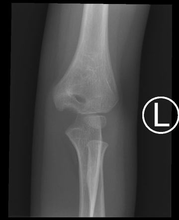 Fishtail deformity of elbow | Radiology Case | Radiopaedia.org