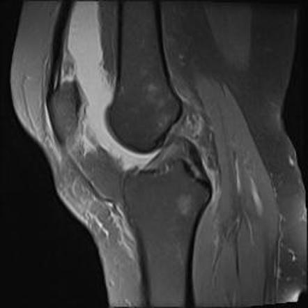 Transient patellar subluxation with osteochondral fragment | Image ...