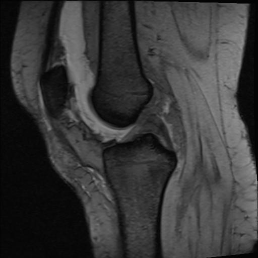 Transient patellar subluxation with osteochondral fragment | Image ...