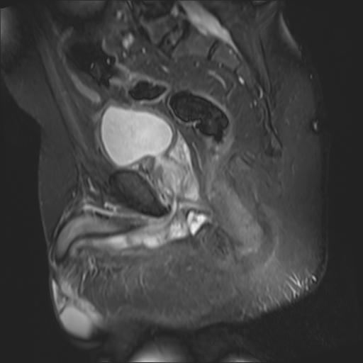 Perineal Abscess Image