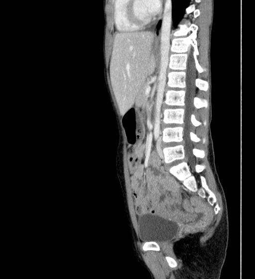 Superior mesenteric artery syndrome | Image | Radiopaedia.org