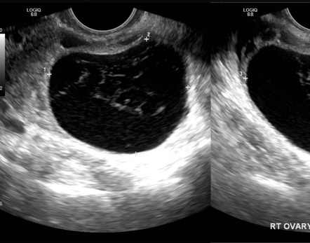 Haemorrhagic ovarian cyst | Radiology Reference Article | Radiopaedia.org