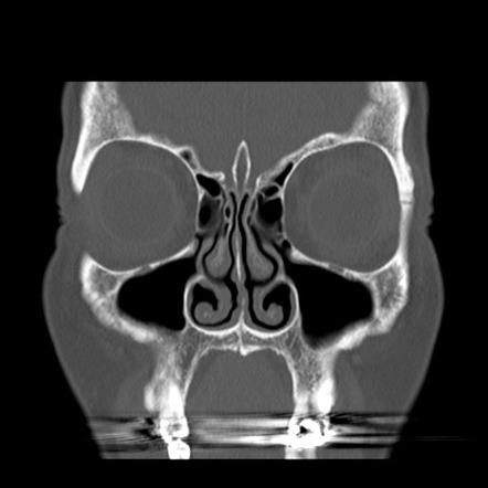 Hydroxyapatite granule cosmetic augmentation | Image | Radiopaedia.org