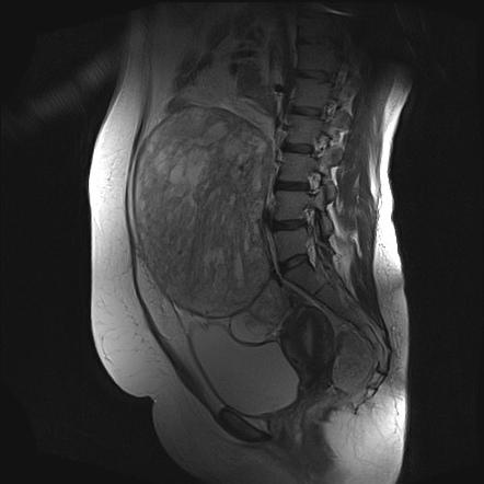 Large broad ligament leiomyoma | Radiology Case | Radiopaedia.org