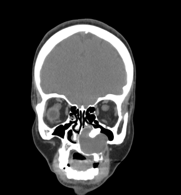 Dentigerous cyst | Image | Radiopaedia.org