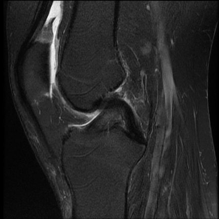 Bilateral knee joint gout on MRI | Image | Radiopaedia.org