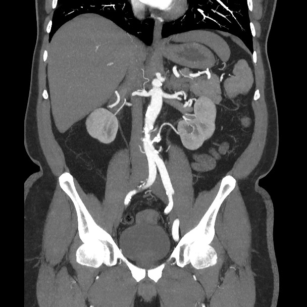 Active colonic bleed on CT | Image | Radiopaedia.org