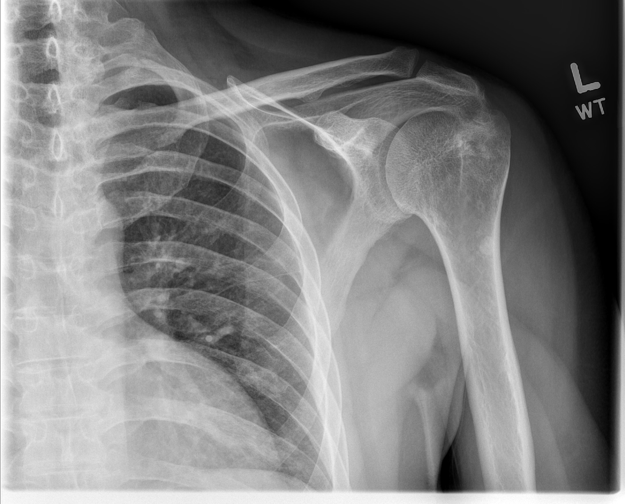 Rotator cuff enthesitis in ankylosing spondylitis | Image | Radiopaedia.org