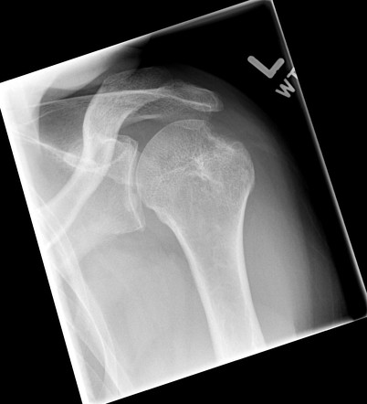 Cotton wool appearance (bone), Radiology Reference Article