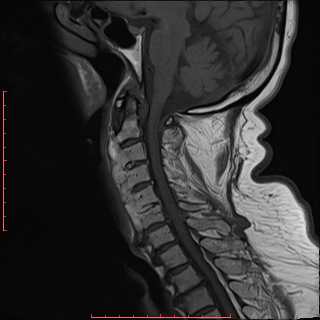 Diffuse idiopathic skeletal hyperostosis (DISH) | Image | Radiopaedia.org