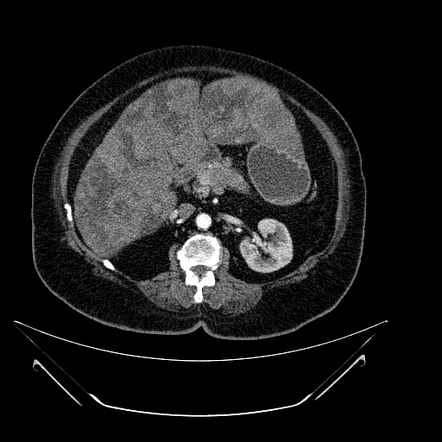 Hepatic metastases from pancreatic cancer | Radiology Case ...