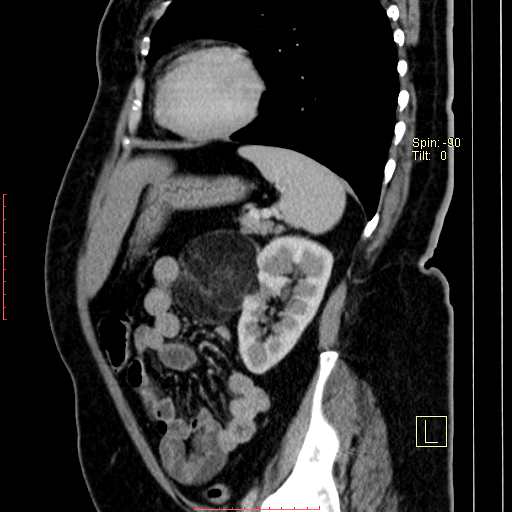 Exophytic Renal Angiomyolipoma Image